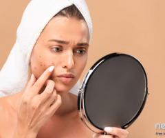 Acne Treatment in Ludhiana