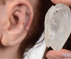 otoplasty surgery in india