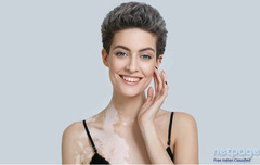 HOW TO SUCCESSFULLY TREAT YOUR VITILIGO?