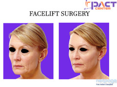Facelift Surgery in Delhi at IPACT Center