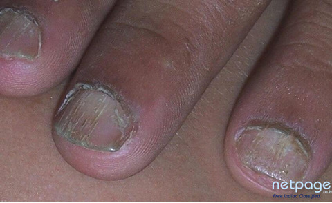 Noticing Unusual Changes In The Nails? Consult a Dermatologist
