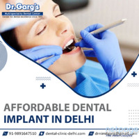 Affordable Dental Implants in Delhi