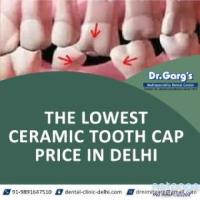 The Lowest Ceramic Tooth Cap Price in Delhi